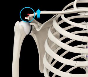 AC Joint Dislocation/Acromioclavicular Joint Dislocation