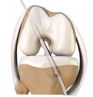 acl-reconstruction