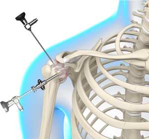 Shoulder Arthroscopy