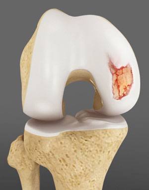 articular-cartilage-injury