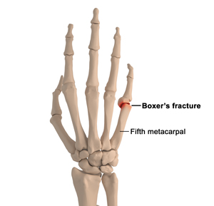 Boxer's Fracture