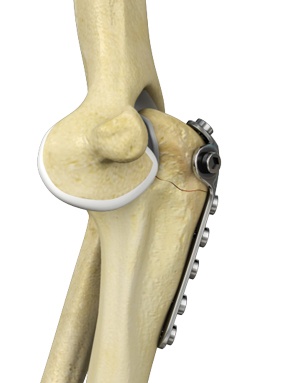 elbow-fracture-reconstruction