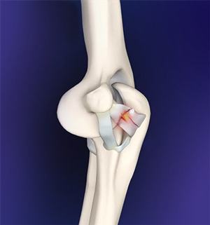 elbow-ligament-reconstruction