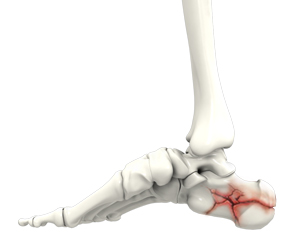 foot-fracture