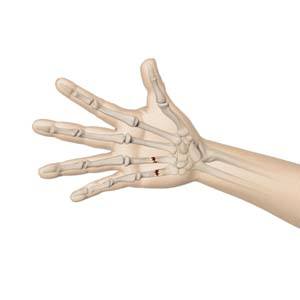 fractures-of-the-hand-and-fingers