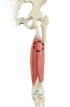 hamstring-injuries