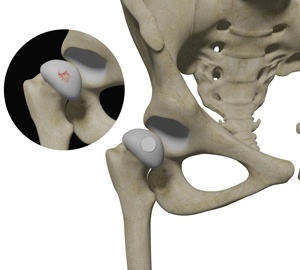 hip-cartilage-restoration
