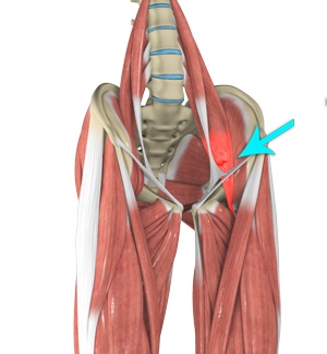 Hip Flexor Strain Key Biscayne, Medford NJ