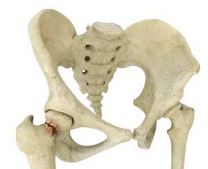 Hip Fracture Surgery