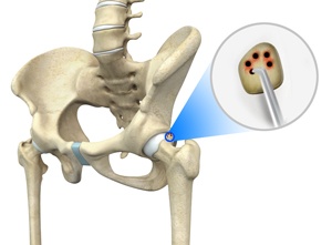 hip-microfracture