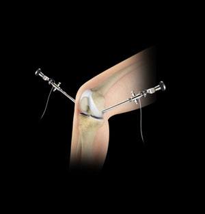 knee-arthroscopy