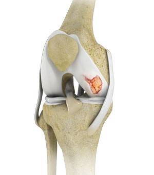 knee-cartilage-restoration