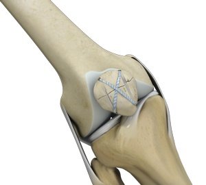 knee-fracture-surgery
