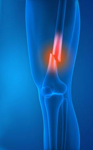 knee-fracture