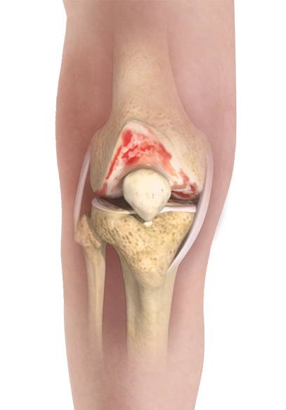 knee-osteoarthritis