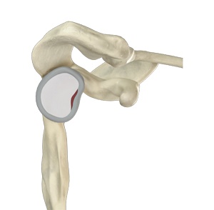 Shoulder Labral Tear