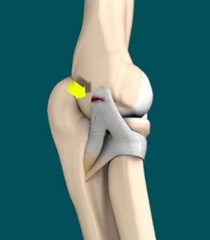 Lateral Ulnar Collateral Ligament Injuries