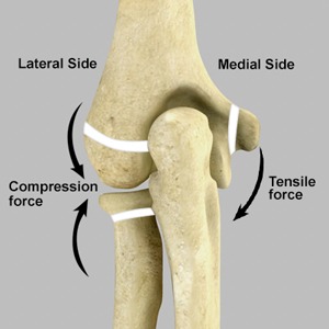 Elbow Fractures