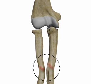 malunion-surgery-elbow