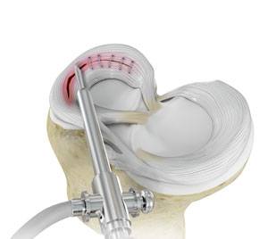 meniscal-surgery