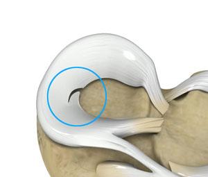 meniscal-tears