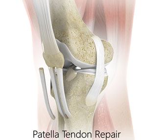 patellar-tendon-repair