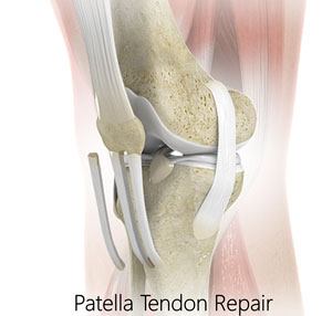 Patellar Tendon Repair