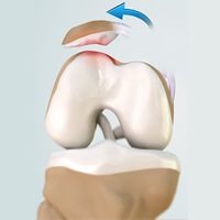 patellofemoral-instability