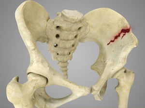 pelvic-fracture