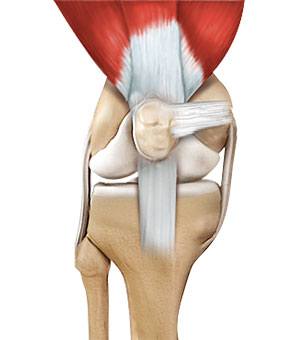 quadriceps-tendon-repair