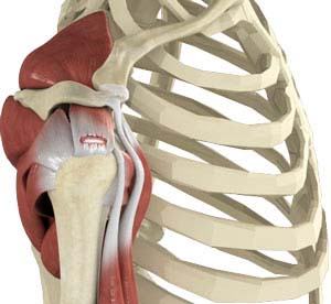 rotator-cuff-tear