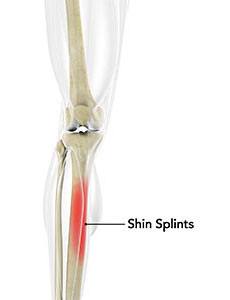 shin-splints